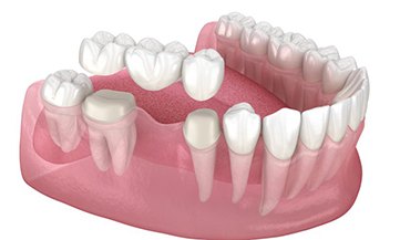 a 3 D example of implant dental bridges