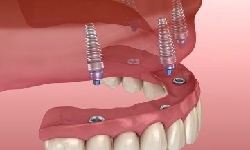 Animated smile during permanent implant denture placement