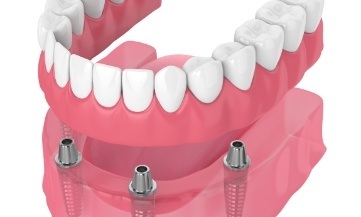Animated smile during removable implant denture placement
