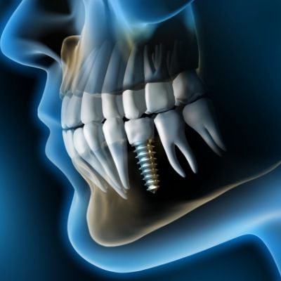 Animated smile line showing dental implant supported tooth compared to natural teeth