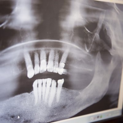 All digital x-rays showing a dental patient's smile