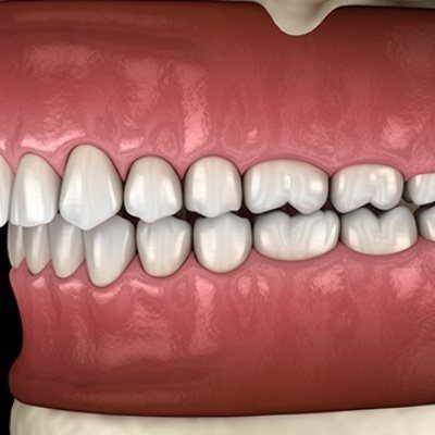 Animated smile in need of equilibration and occlusal adjustment